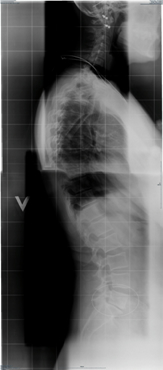 røntgenbilde
